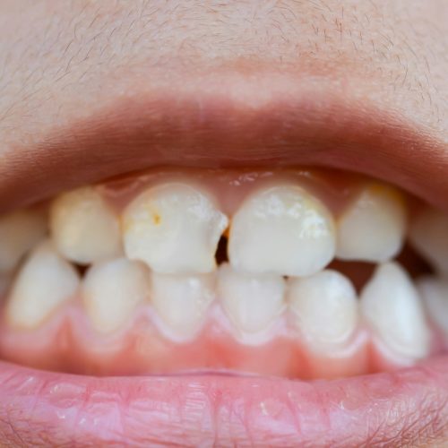 A zoomed-in image captures the mouths of children with misaligned, fractured teeth and odontolith.