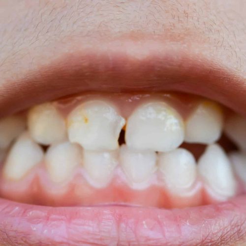 A zoomed-in image captures the mouths of children with misaligned, fractured teeth and odontolith. A zoomed-in image captures the mouths of children with misaligned, fractured teeth and odontolith.