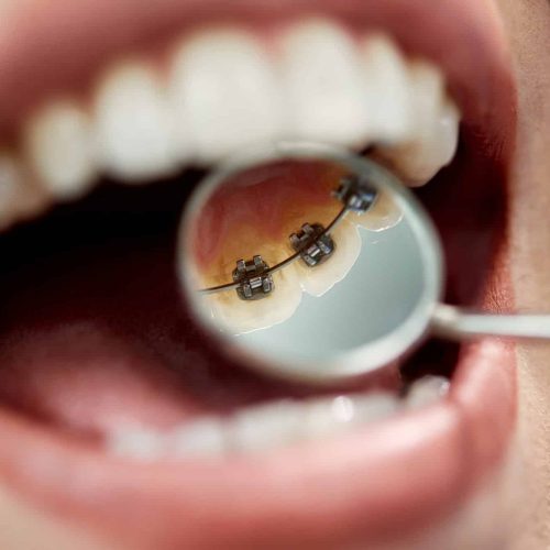 Close-up of woman having lingual braces check-up by orthodontist at dentist’s office. Close-up of woman having lingual braces check-up by orthodontist at dentist's office.
