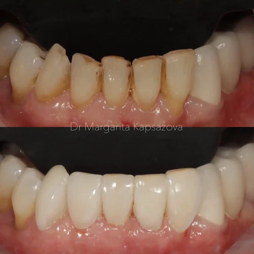 composite bonding high wycombe